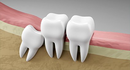 Wisdom Teeth Extractions