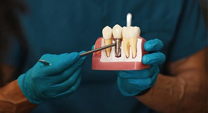 Dental Implants