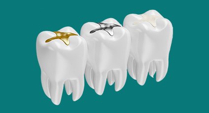 Composite Fillings